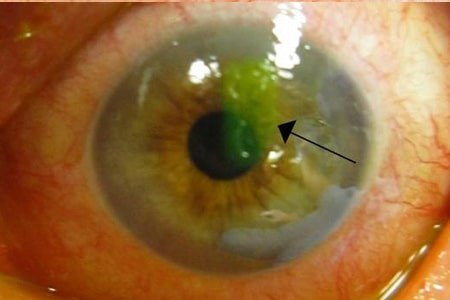 Recurrent-corneal-erosion-syndrome